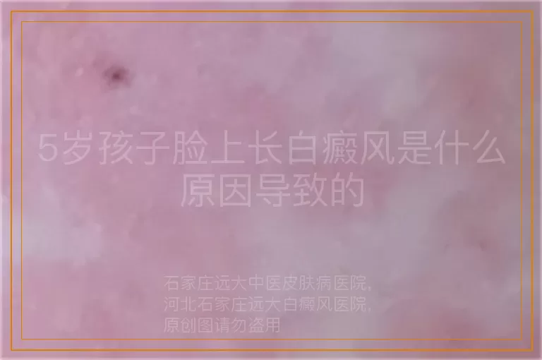 5岁孩子脸上长白癜风是什么原因导致的