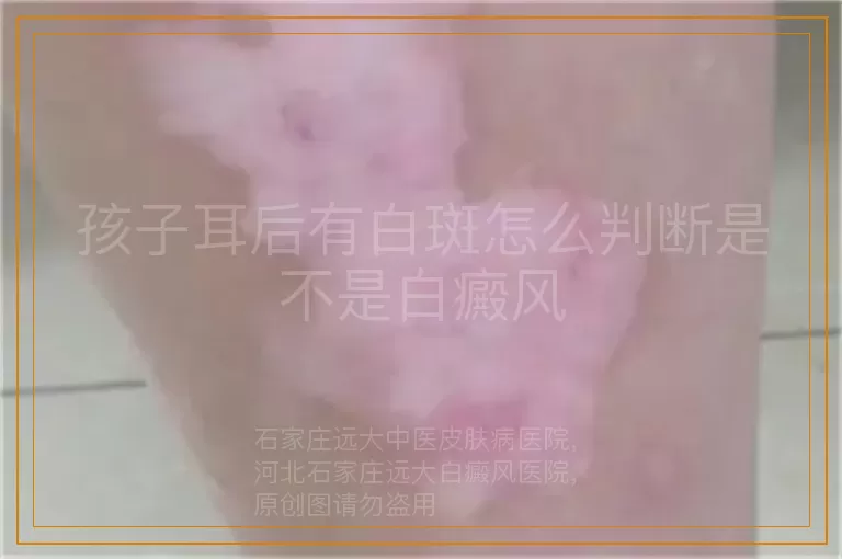 孩子耳后有白斑怎么判断是不是白癜风