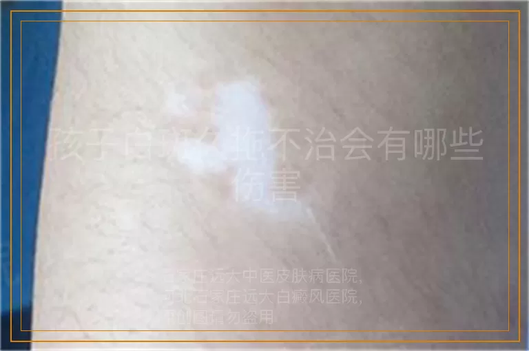 孩子白斑久拖不治会有哪些伤害