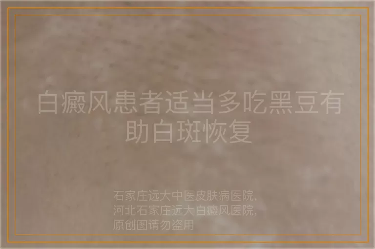 白癜风患者适当多吃黑豆有助白斑恢复