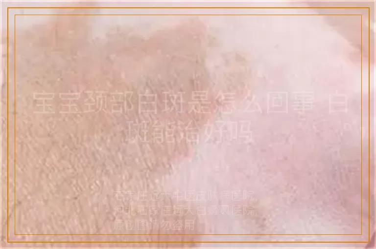 宝宝颈部白斑是怎么回事 白斑能治好吗