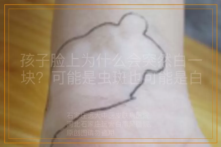 孩子脸上为什么会突然白一块？可能是虫斑也可能是白癜风