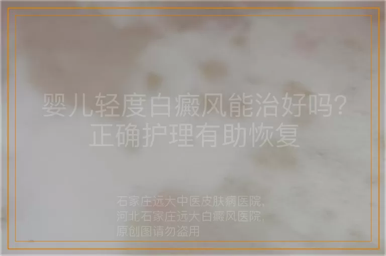 婴儿轻度白癜风能治好吗？正确护理有助恢复