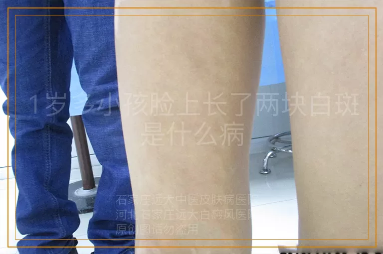 1岁多小孩脸上长了两块白斑是什么病