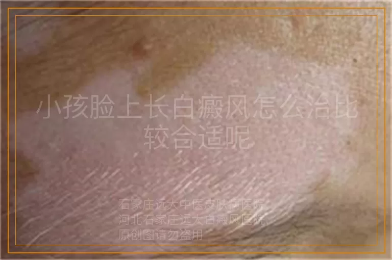 小孩脸上长白癜风怎么治比较合适呢