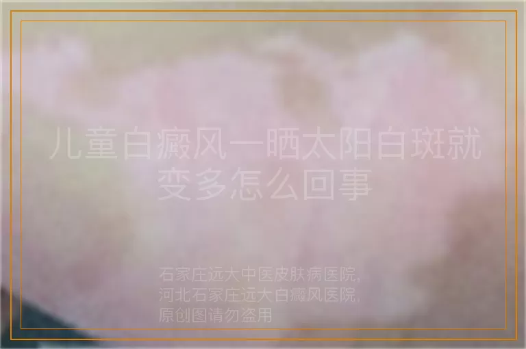 儿童白癜风一晒太阳白斑就变多怎么回事