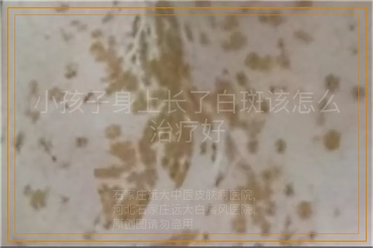 小孩子身上长了白斑该怎么治疗好