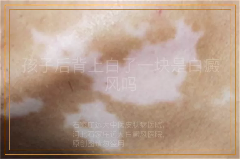 孩子后背上白了一块是白癜风吗