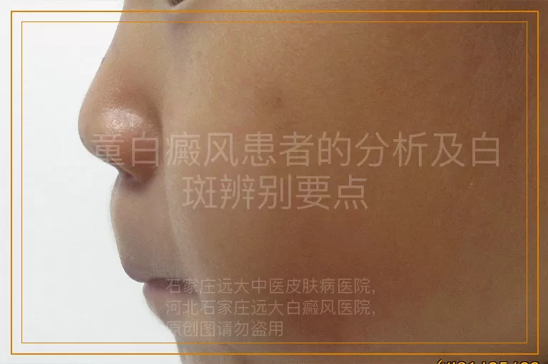 儿童白癜风患者的分析及白斑辨别要点
