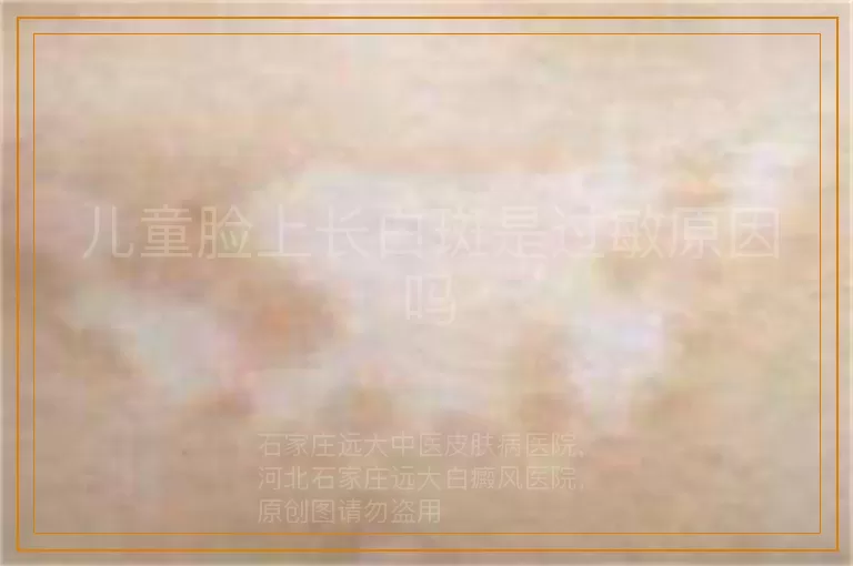 儿童脸上长白斑是过敏原因吗