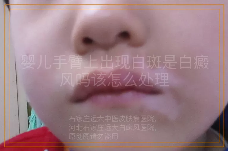 婴儿手臂上出现白斑是白癜风吗该怎么处理