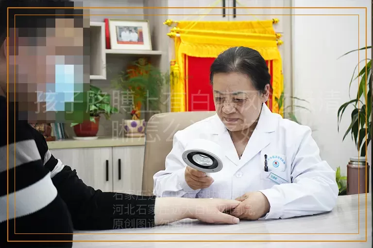 孩子胳膊上有白癜风边缘清晰怎么治疗好