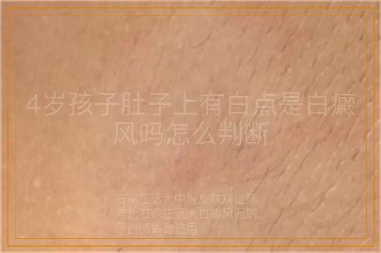 4岁孩子肚子上有白点是白癜风吗怎么判断