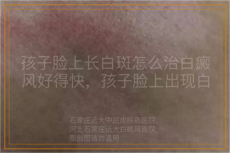 孩子脸上长白斑怎么治白癜风好得快，孩子脸上出现白癜风如何治疗效果好，儿童脸上有块白癜风怎样治疗能恢复