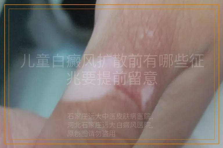 儿童白癜风扩散前有哪些征兆要提前留意