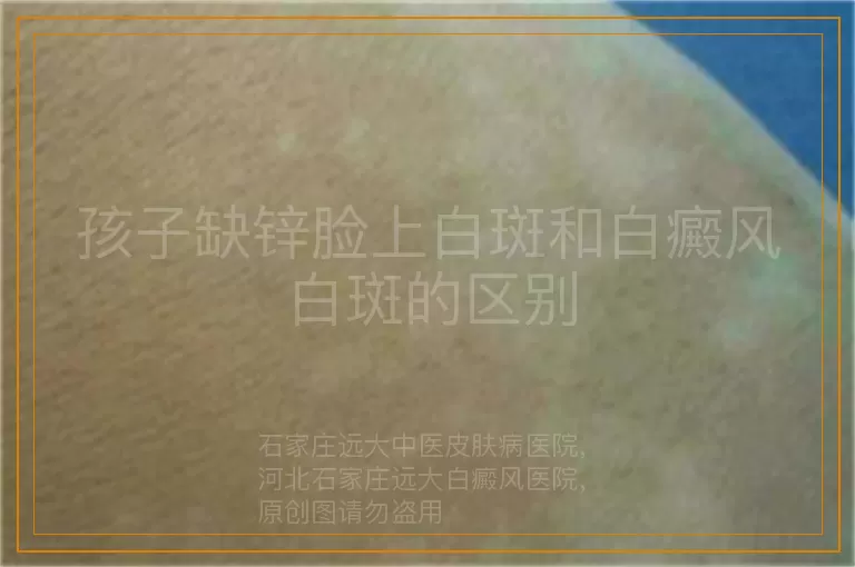 孩子缺锌脸上白斑和白癜风白斑的区别