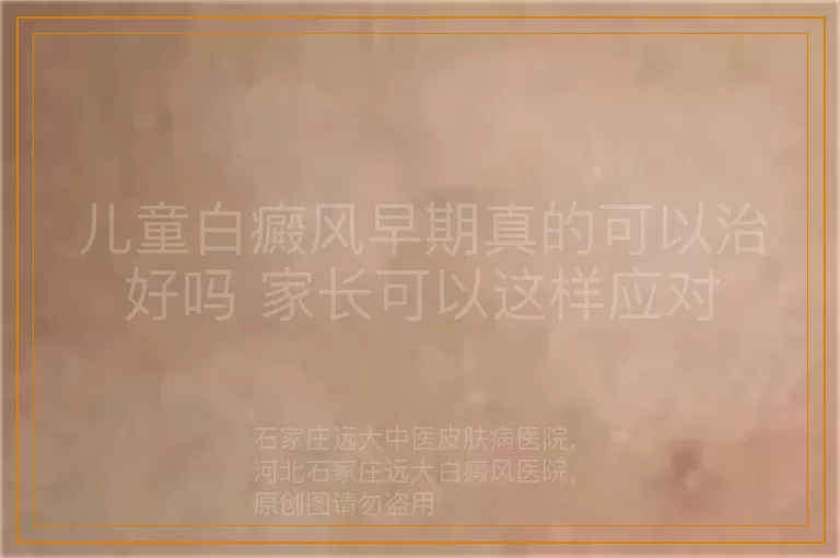 儿童白癜风早期真的可以治好吗 家长可以这样应对