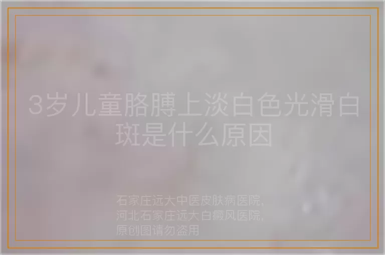3岁儿童胳膊上淡白色光滑白斑是什么原因
