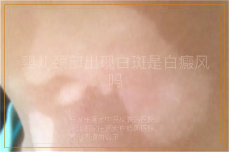 婴儿颈部出现白斑是白癜风吗
