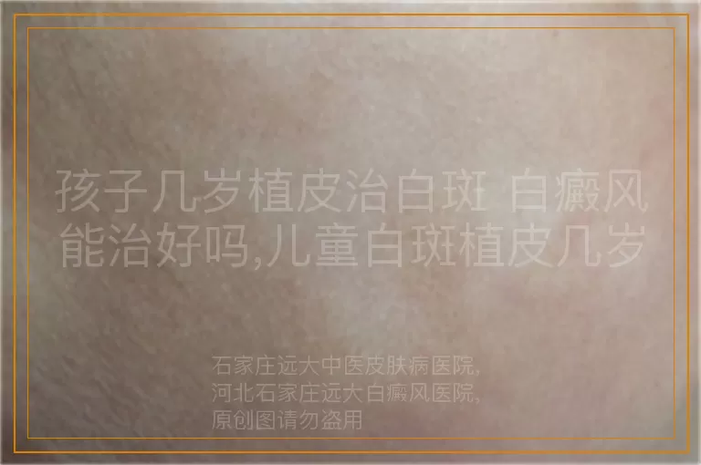 孩子几岁植皮治白斑 白癜风能治好吗,儿童白斑植皮几岁做 白癜风能治好吗,白斑植皮多大能做 白癜风能治好吗