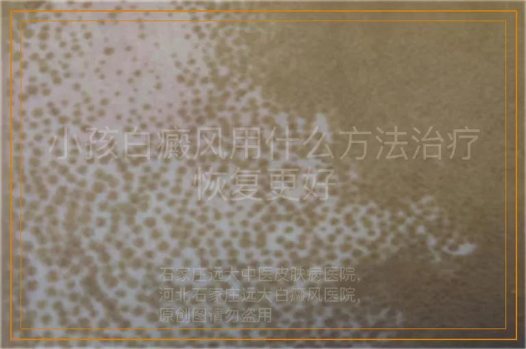 小孩白癜风用什么方法治疗恢复更好