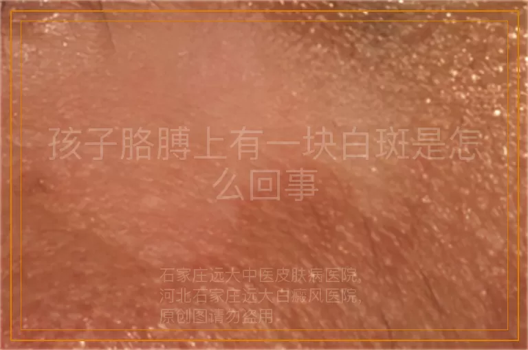 孩子胳膊上有一块白斑是怎么回事