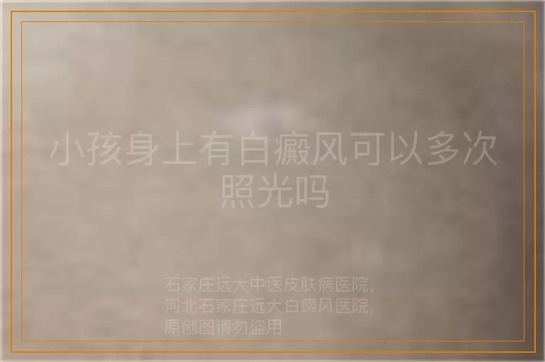 小孩身上有白癜风可以多次照光吗