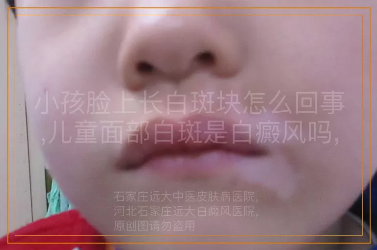 小孩脸上长白斑块怎么回事,儿童面部白斑是白癜风吗,孩子脸上有白斑什么原因