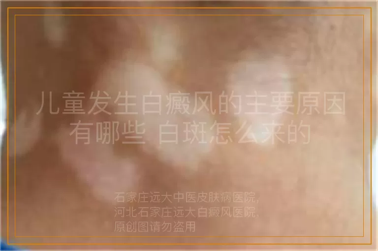 儿童发生白癜风的主要原因有哪些 白斑怎么来的