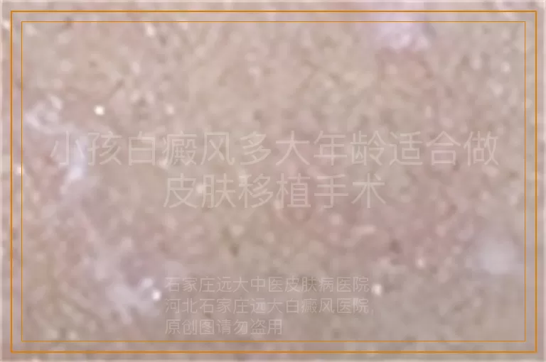 小孩白癜风多大年龄适合做皮肤移植手术