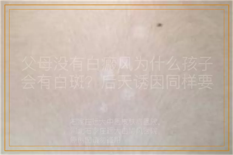 父母没有白癜风为什么孩子会有白斑？后天诱因同样要当心