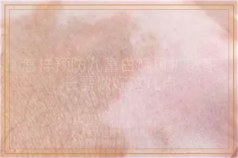 怎样预防儿童白癜风扩散家长需做好这几点