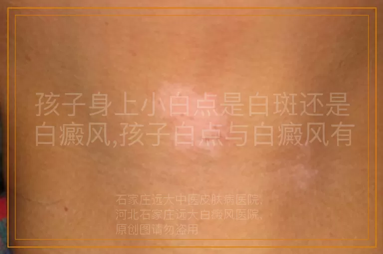 孩子身上小白点是白斑还是白癜风,孩子白点与白癜风有关吗,孩子皮肤小白点属于白斑吗