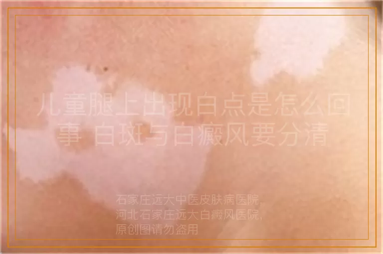 儿童腿上出现白点是怎么回事 白斑与白癜风要分清