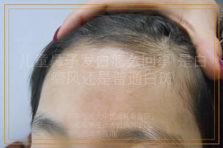 儿童鼻子发白怎么回事 是白癜风还是普通白斑