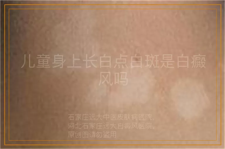 儿童身上长白点白斑是白癜风吗