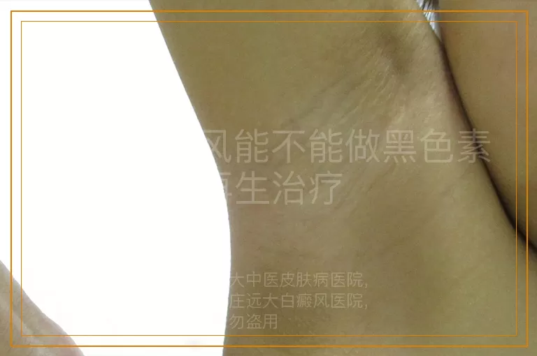 小孩白癜风能不能做黑色素再生治疗
