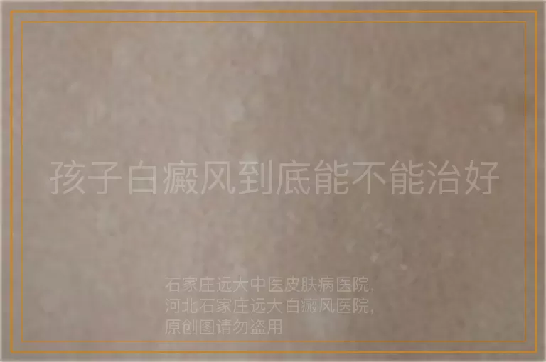 孩子白癜风到底能不能治好
