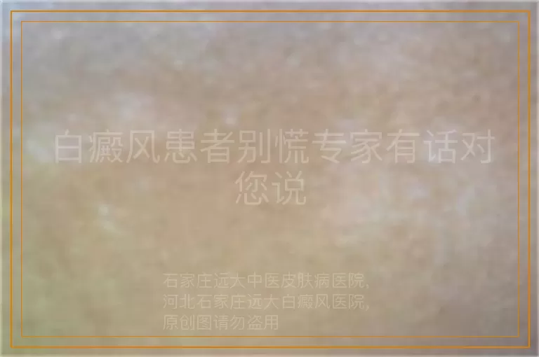 白癜风患者别慌专家有话对您说