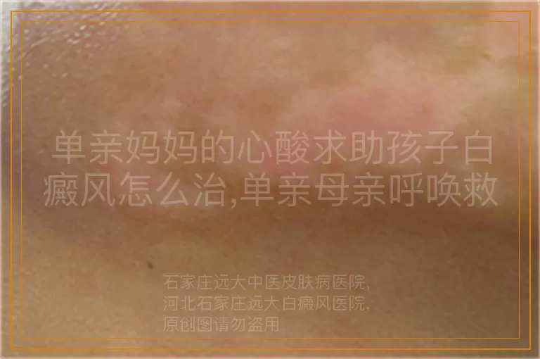 单亲妈妈的心酸求助孩子白癜风怎么治,单亲母亲呼唤救救白癜风孩子方法,单亲妈妈含泪问孩子白斑能恢复吗