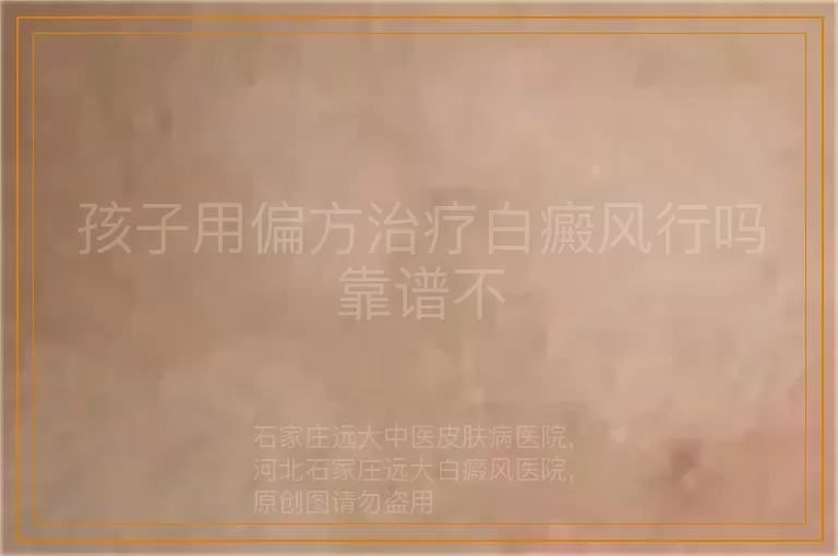 孩子用偏方治疗白癜风行吗靠谱不