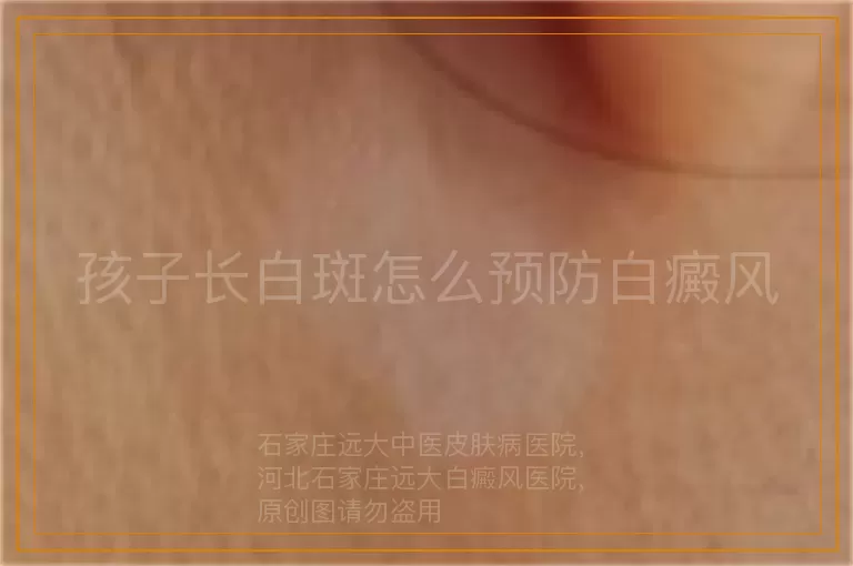 孩子长白斑怎么预防白癜风