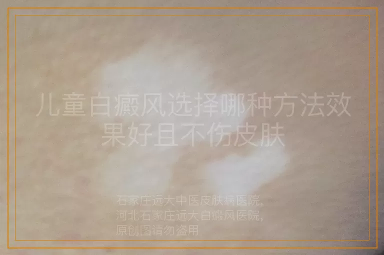 儿童白癜风选择哪种方法效果好且不伤皮肤