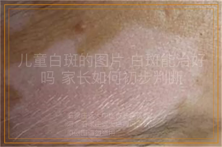 儿童白斑的图片 白斑能治好吗 家长如何初步判断