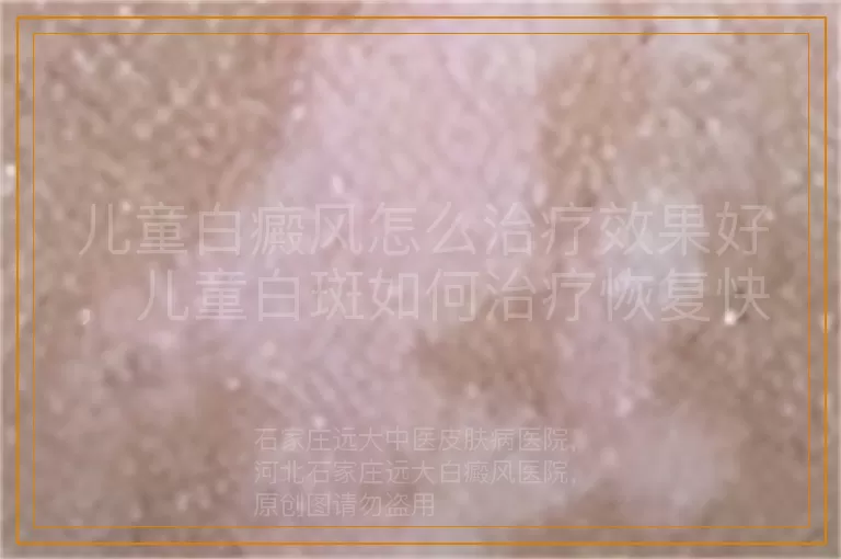 儿童白癜风怎么治疗效果好，儿童白斑如何治疗恢复快，小儿白癜风怎样治疗效果佳