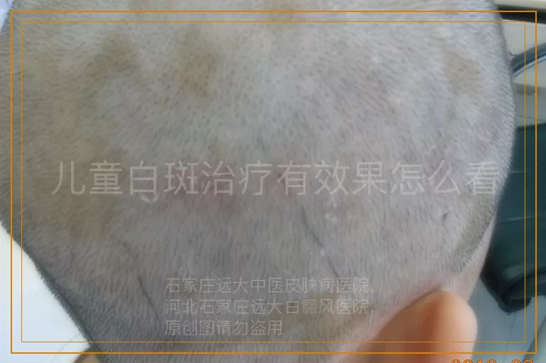 儿童白斑治疗有效果怎么看