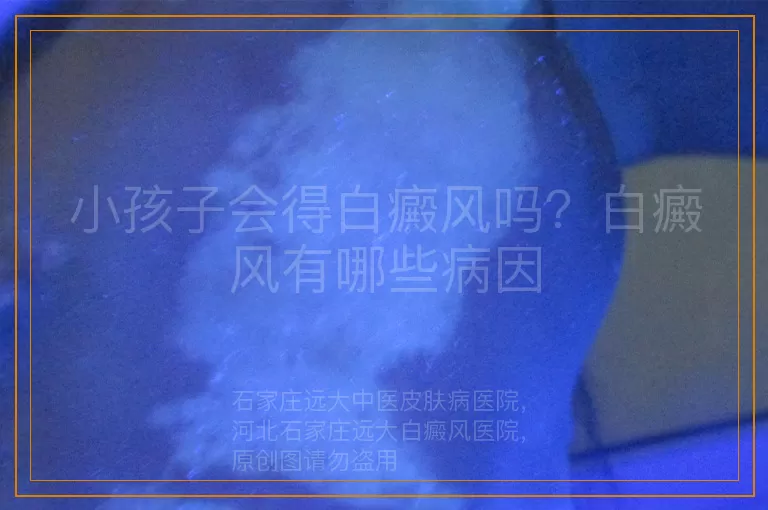 小孩子会得白癜风吗？白癜风有哪些病因