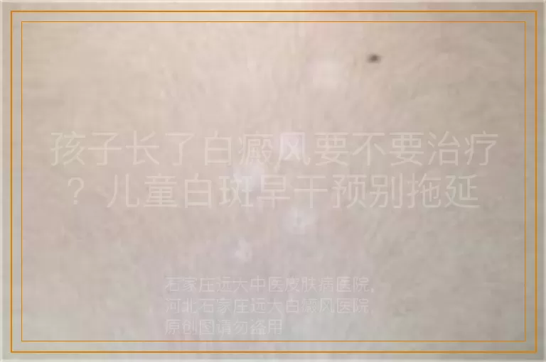孩子长了白癜风要不要治疗？儿童白斑早干预别拖延