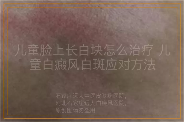 儿童脸上长白块怎么治疗 儿童白癜风白斑应对方法