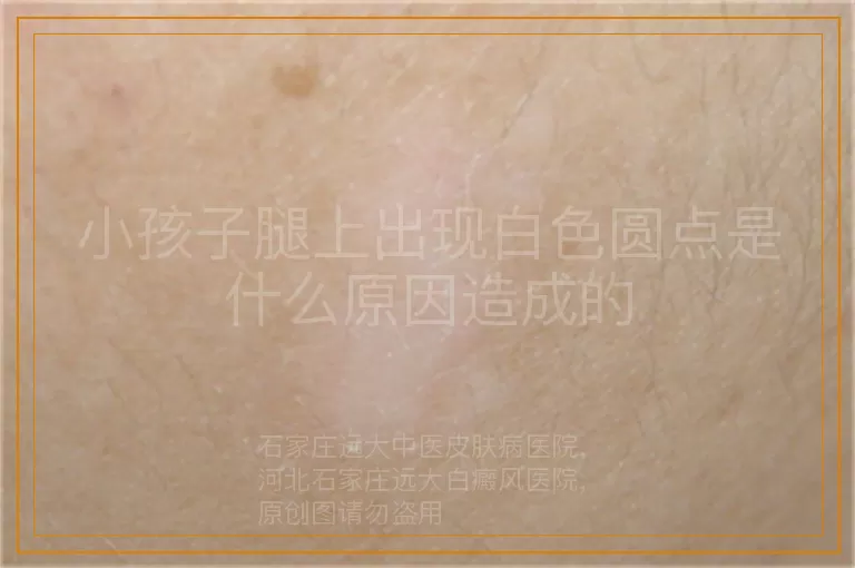 小孩子腿上出现白色圆点是什么原因造成的